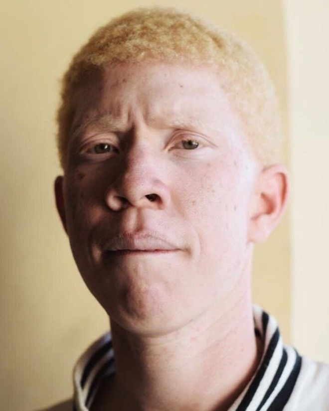 Как выглядят альбиносы разных национальностей и рас 47
