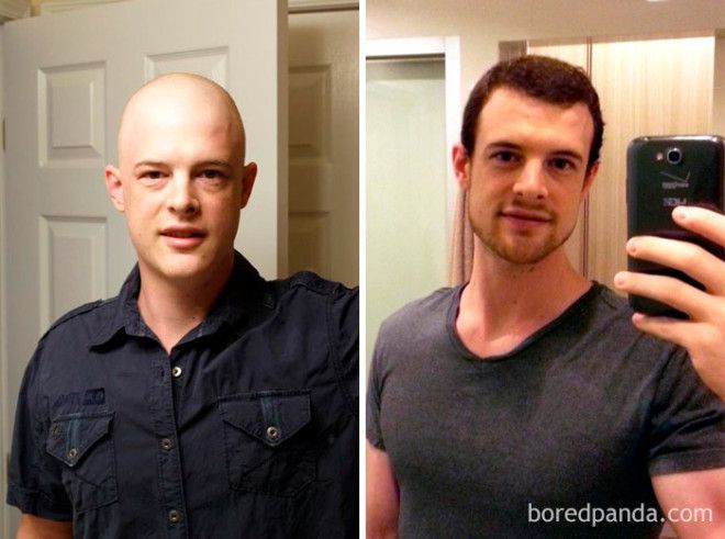 Люди, которые победили рак, в фотографиях до и после 41