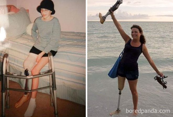 Люди, которые победили рак, в фотографиях до и после 42
