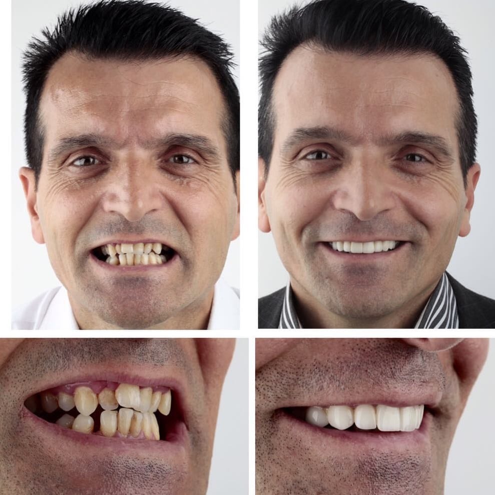 Зубы в 40 лет фото