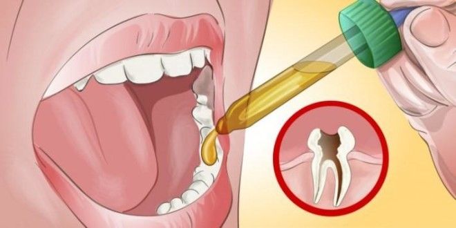 Самый действенный метод избавления от зубной боли! 12