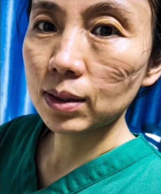 Врачи показали, как выглядят их лица после смен в больницах, где они помогают пациентам с коронавирусом 28