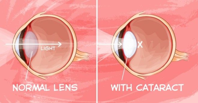 BКатаракта причины симптомы факторы риска